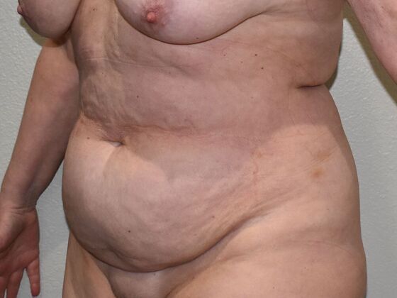 Tummy Tuck (Abdominoplasty): Case 422 - Before