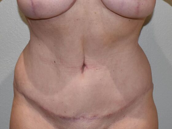 Tummy Tuck (Abdominoplasty): Case 422 - After