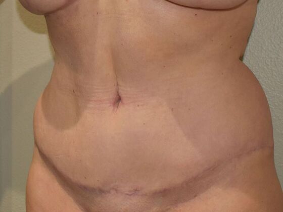 Tummy Tuck (Abdominoplasty): Case 422 - After
