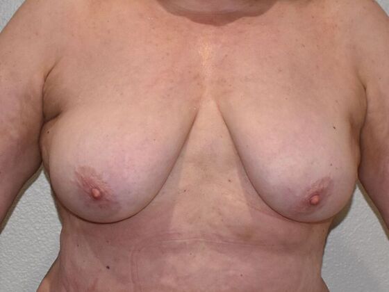 Breast Lift (Mastopexy) Case 171 - Before