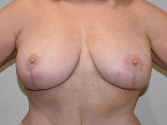 Breast Lift (Mastopexy) Case 171 - After