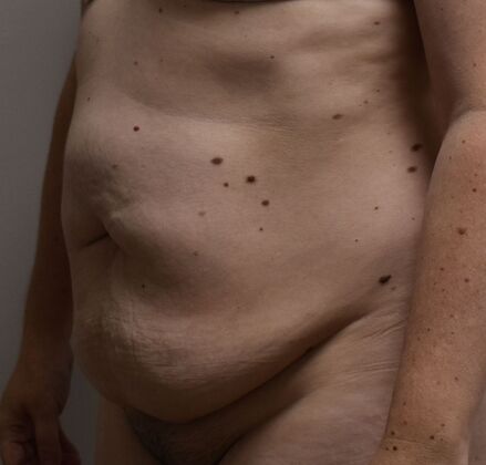 Tummy Tuck (Abdominoplasty): Case 423 - Before