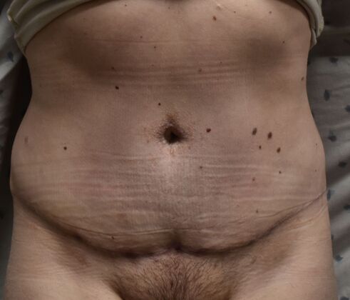 Tummy Tuck (Abdominoplasty): Case 423 - After