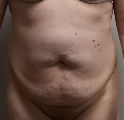 Tummy Tuck (Abdominoplasty): Case 423 - Before