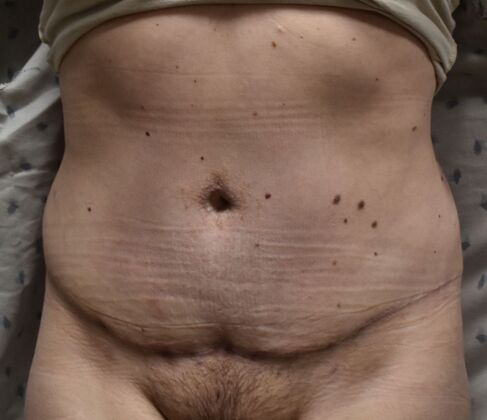 Tummy Tuck (Abdominoplasty): Case 423 - After