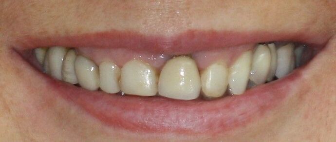Porcelain Veneers and Crowns: Case 7 - Before