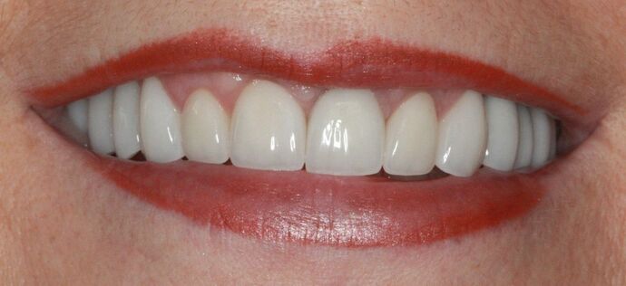 Porcelain Veneers and Crowns: Case 7 - After