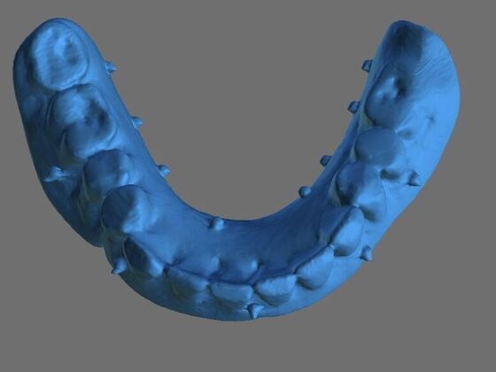 Implant Supported Prosthetics: Case 4 - Before