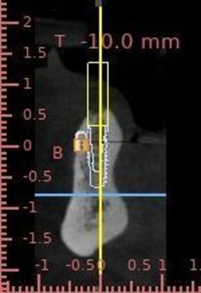 Implant Supported Prosthetics: Case 4 - Before