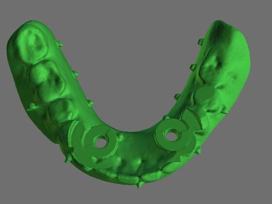 Implant Supported Prosthetics: Case 4 - After