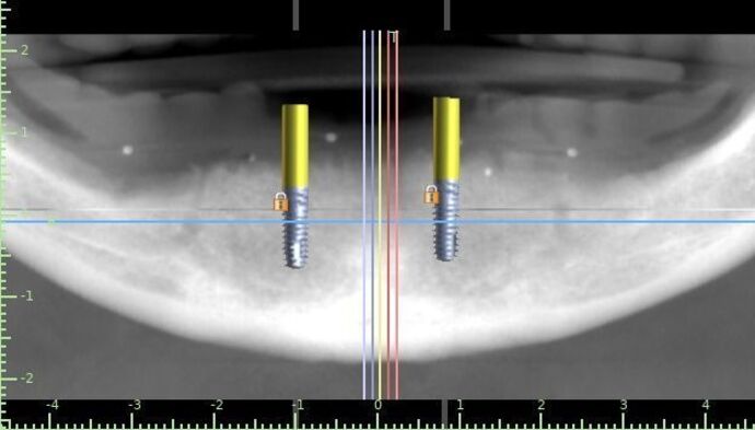 Implant Supported Prosthetics: Case 4 - After