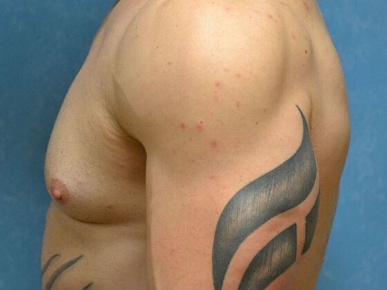 Gynecomastia: Case 1514- Perrysburg, OH - Before