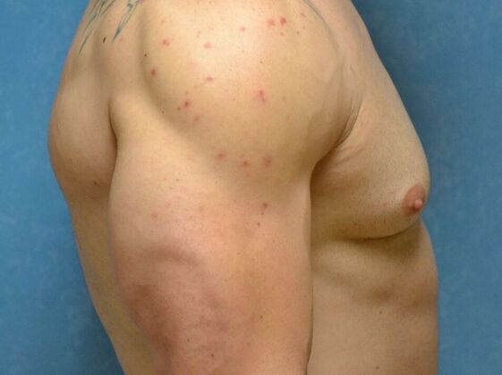 Gynecomastia: Case 1514- Perrysburg, OH - Before