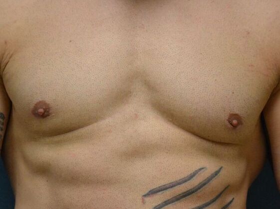 Gynecomastia Case 1514- Perrysburg, OH - After