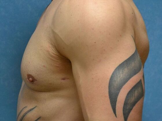 Gynecomastia: Case 1514- Perrysburg, OH - After
