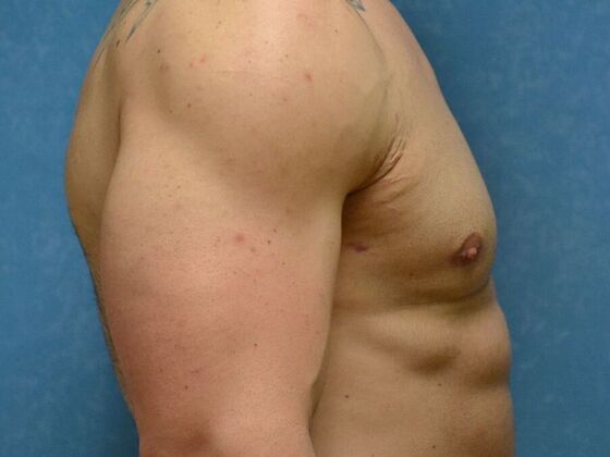 Gynecomastia: Case 1514- Perrysburg, OH - After