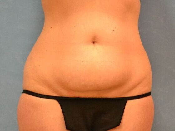 Tummy Tuck: Case 1814- Wayne, OH - Before