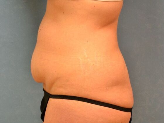 Tummy Tuck: Case 1814- Wayne, OH - Before