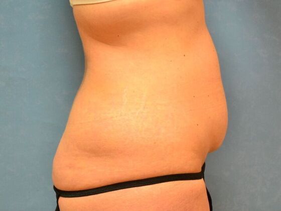 Tummy Tuck: Case 1814- Wayne, OH - Before