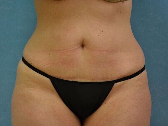 Tummy Tuck: Case 1814- Wayne, OH - After