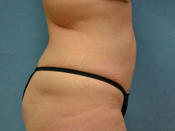 Tummy Tuck: Case 1814- Wayne, OH - After