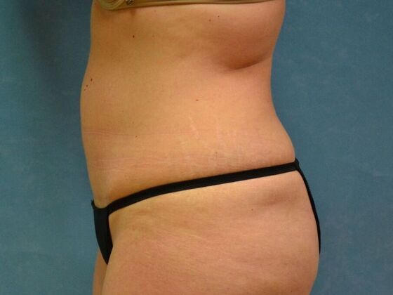 Tummy Tuck: Case 1814- Wayne, OH - After