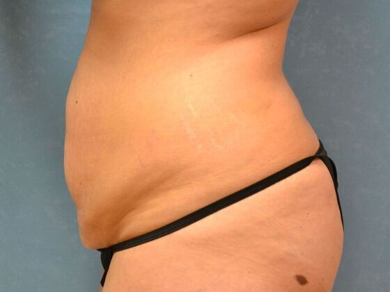 Tummy Tuck: Case 1815- Van Buren, OH - Before