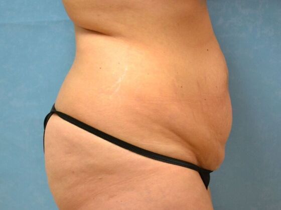 Tummy Tuck: Case 1815- Van Buren, OH - Before