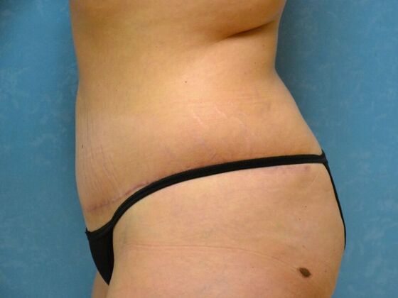 Tummy Tuck: Case 1815- Van Buren, OH - After