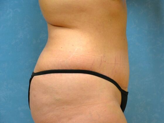 Tummy Tuck: Case 1815- Van Buren, OH - After