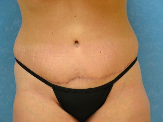 Tummy Tuck Case 1815- Van Buren, OH - After