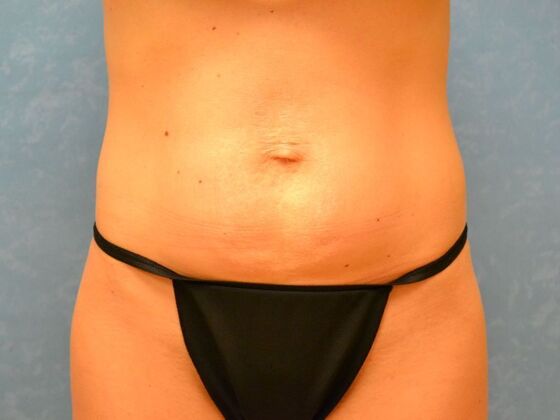 Tummy Tuck: Case 1816- Montpelier, OH - Before