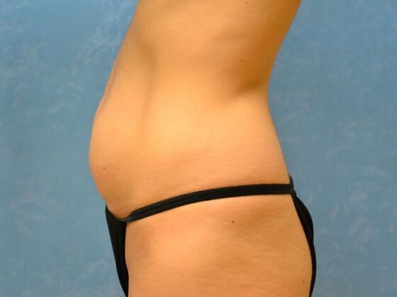 Tummy Tuck: Case 1816- Montpelier, OH - Before