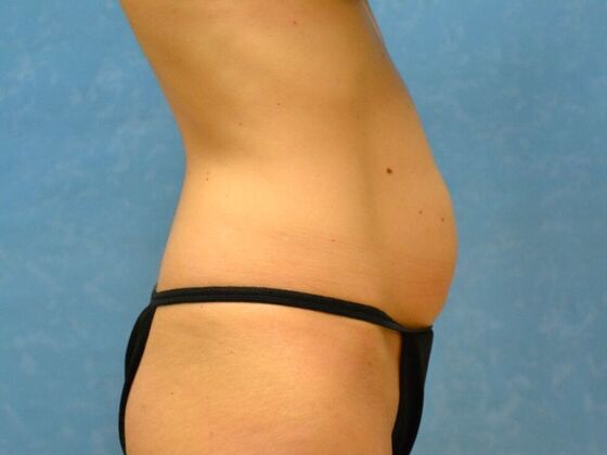 Tummy Tuck: Case 1816- Montpelier, OH - Before