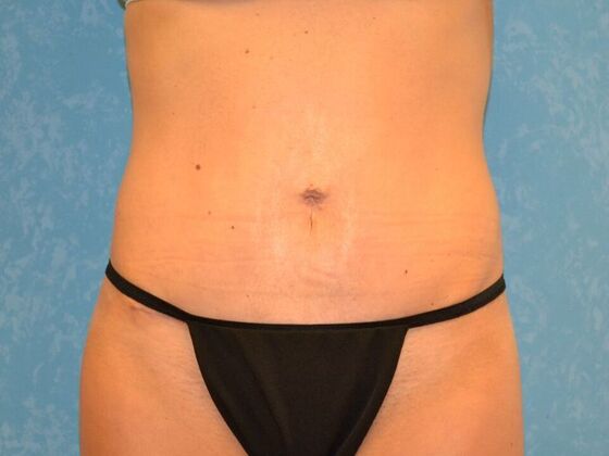 Tummy Tuck: Case 1816- Montpelier, OH - After