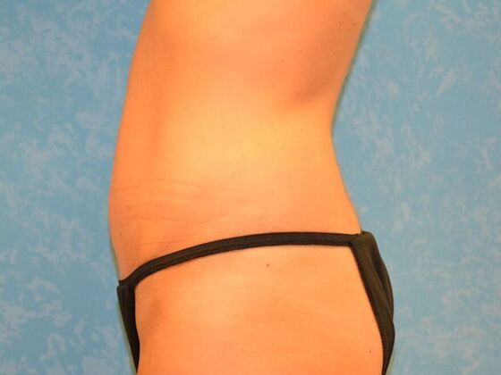 Tummy Tuck: Case 1816- Montpelier, OH - After