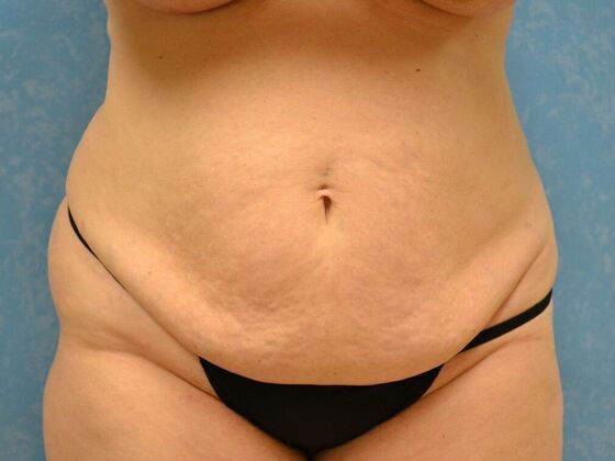Tummy Tuck Case 1817- Sylvania, OH - Before