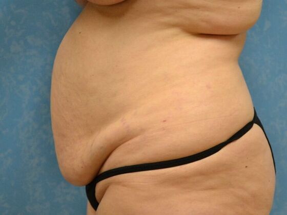 Tummy Tuck: Case 1817- Sylvania, OH - Before