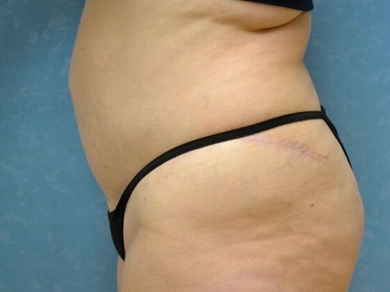 Tummy Tuck: Case 1817- Sylvania, OH - After