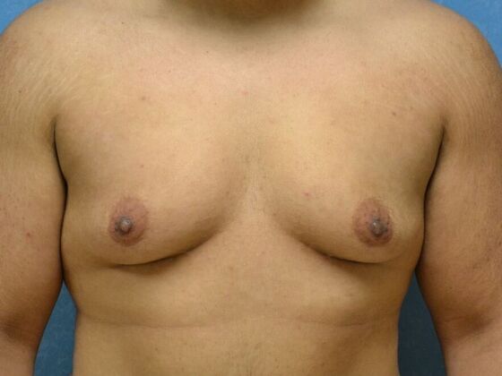 Gynecomastia Case 1515- Columbus, OH - Before