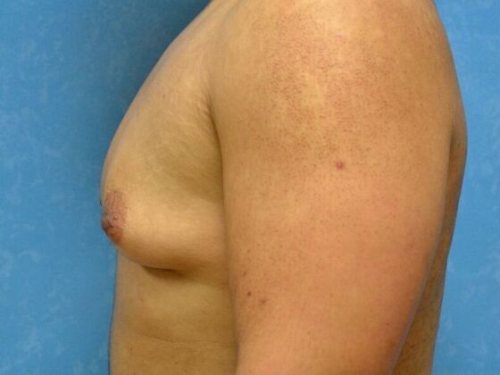 Gynecomastia: Case 1515- Columbus, OH - Before