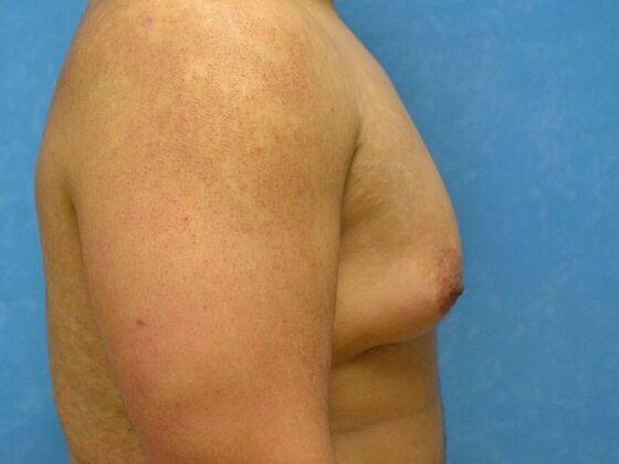 Gynecomastia: Case 1515- Columbus, OH - Before