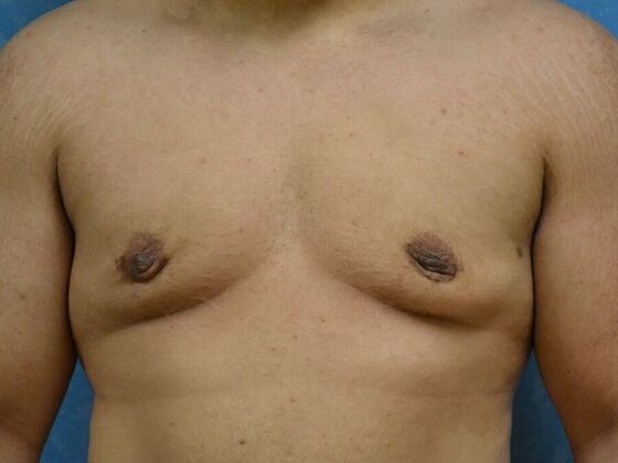 Gynecomastia Case 1515- Columbus, OH - After