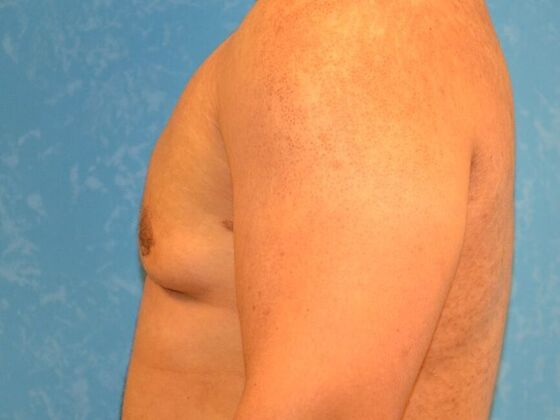 Gynecomastia: Case 1515- Columbus, OH - After