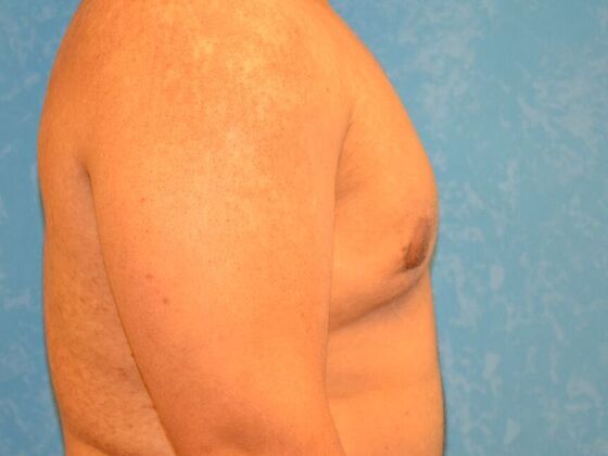 Gynecomastia: Case 1515- Columbus, OH - After
