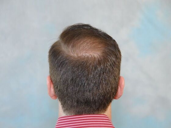 FUT Scars Case 1 - Before