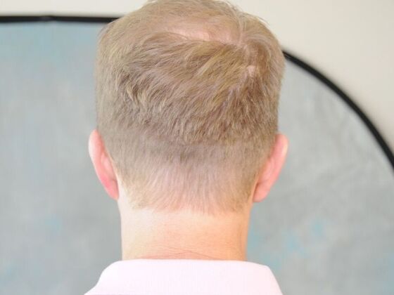 FUT Scars: Case 2 - Before