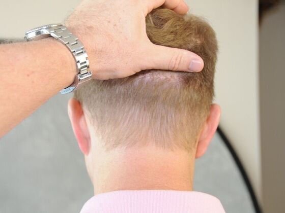 FUT Scars: Case 2 - After