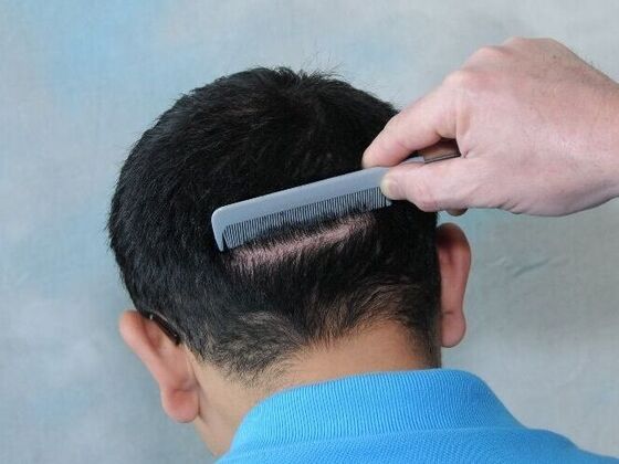 FUT Scars Case 3 - After