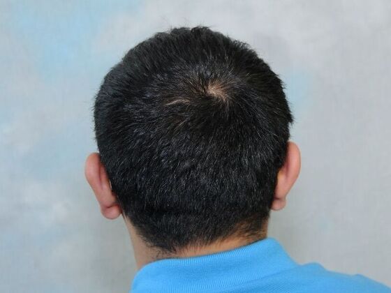 FUT Scars Case 3 - Before